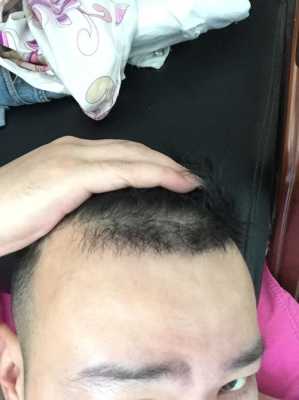 额头两侧头发少怎么办（额头两边头发越来越少）