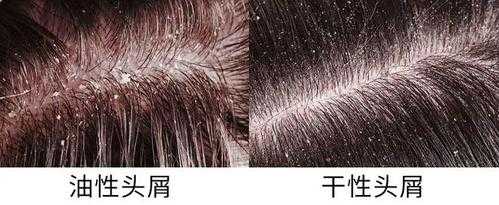 为什么秋天的头发比夏天更油,为什么到秋天头屑多年没好