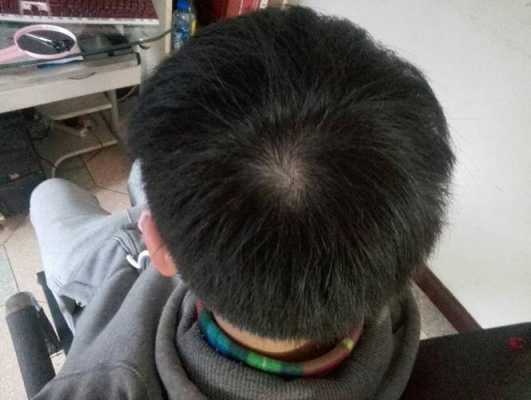 青少年戒掉头发能长回来吗,青少年脱发怎么冶疗最好