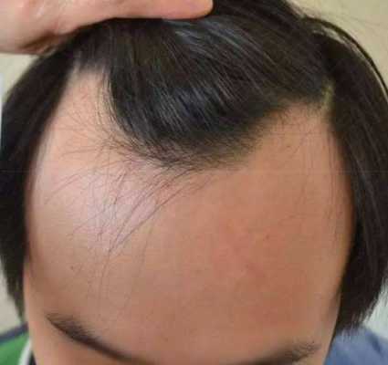 青少年戒掉头发能长回来吗,青少年脱发怎么冶疗最好