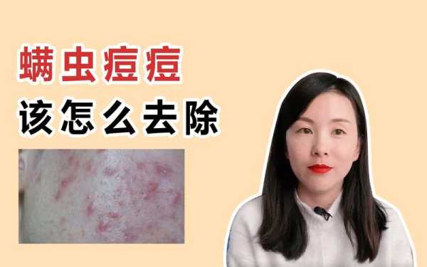 脸上长痘痘怎么消除,脸上起粉刺怎么去掉小妙招