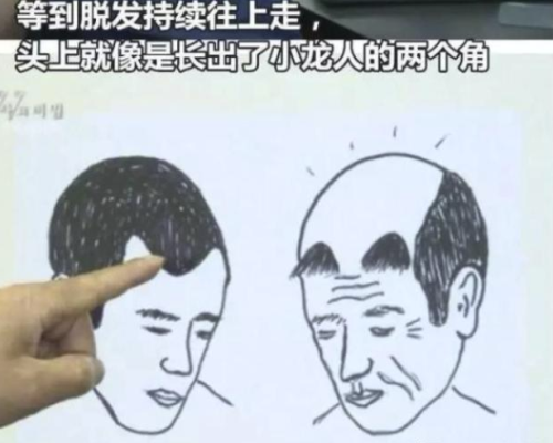 青少年如何防止秃顶,少年秃顶怎么治疗