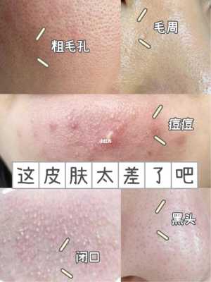 毛孔粗大有黑头是什么原因（怎么解决黑头毛孔粗大）