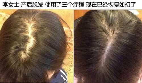 脂溢性脱发怎么治好（脂溢性脱发怎么生发）