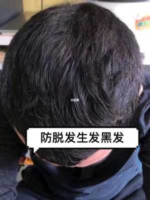 脂溢性脱发怎么治好（脂溢性脱发怎么生发）