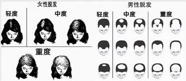 梳头不掉头发洗头为什么会掉头发,梳头掉头发是什么原因引起的