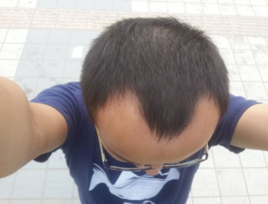 两鬓脱发是什么原因（两鬓脱发是什么原因引起的）