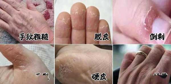 冬天手干燥粗糙还脏洗不干净,冬季手干燥粗糙怎么护理