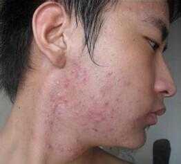 男的下面长痘痘是什么原因（我的下面长痘痘怎么办）