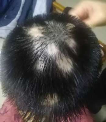 头发班秃是什么原因因起（头发出现班秃的原因）