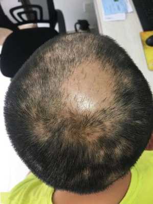 头发班秃是什么原因因起（头发出现班秃的原因）