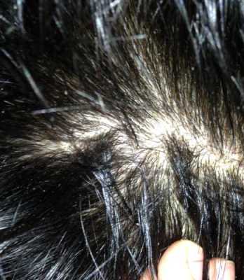 男生头皮屑多是什么原因（男生头皮屑多是什么原因引起的）
