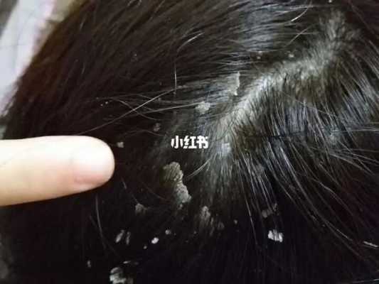 头皮屑多大块是什么原因（头皮屑多大块是什么原因）