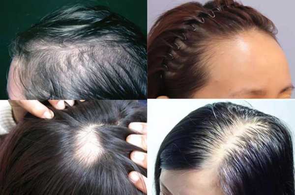 女生掉头发很厉害是什么原因（女生掉头发很厉害是什么原因引起的）