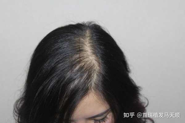 女生掉头发比较厉害是什么原因（女生掉头发比较厉害是什么原因）