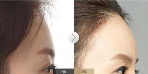 什么样的额头叫高额头,高额头是什么意思
