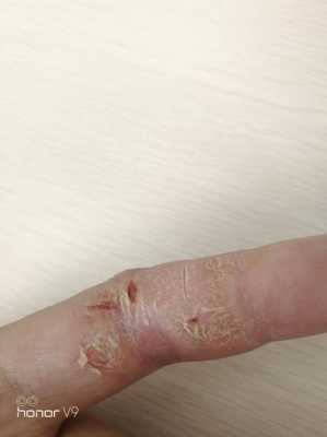 手指裂开口子如何处理，手指裂口子的原因,手指皮肤干裂怎么办图片