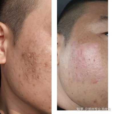 痘坑最佳消除方法,痘坑怎么修复小妙招图片