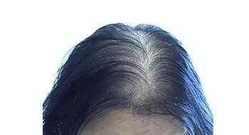 女人脂溢性脱发怎么治（女人脂溢性脱发怎么治疗）