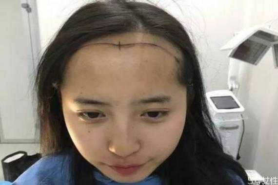 什么是额头大（额头多长才算大）