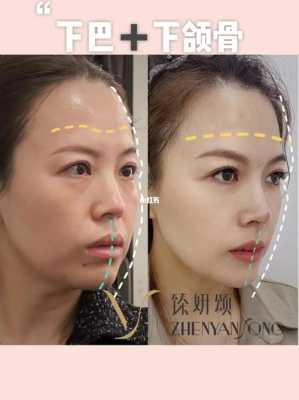 手机下巴宽是指什么,什么是宽下巴和窄下巴