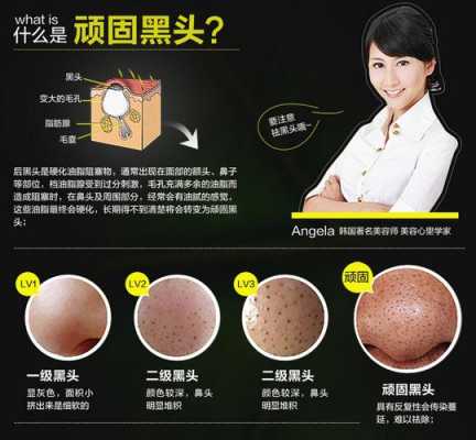 黑色粉刺怎么来的（黑色粉刺是什么原因）