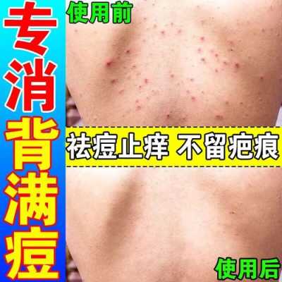 背部长痘痘怎么消除（后背长痘痘怎么消除用什么药）
