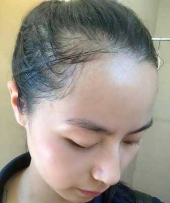 发际线为什么会后移,发际线为什么后移了