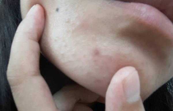 下巴上的粉刺怎么去掉（下巴上的粉刺怎么去掉图片）