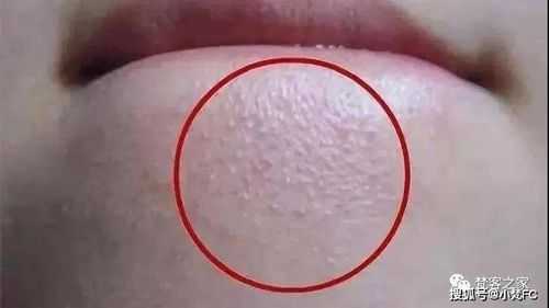 下巴上的粉刺怎么去掉（下巴上的粉刺怎么去掉图片）