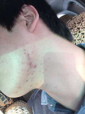 下巴长痘痘怎么治疗,下颚长痘痘怎么治疗最有效