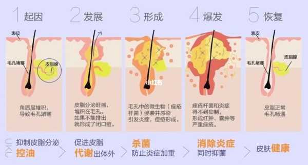 粉刺痤疮是怎么生成的（粉刺痤疮是怎么生成的）