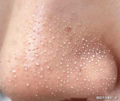 大黑头怎么去除最有效（黑头粉刺毛孔粗大怎么去除最有效）