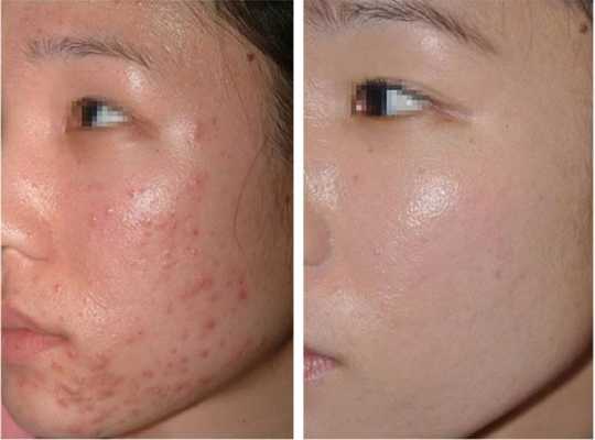 脸上有痘疤怎么消除（脸上有痘疤怎么消除小妙招）