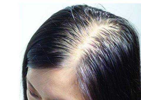 烫发导致脱发怎么办（烫发导致脱发怎么办女生）