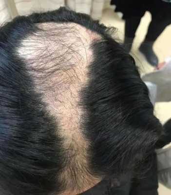 秃顶是什么引起的,均匀脱发是什么导致的