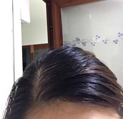 头发出油掉发厉害怎么办,头油掉发怎么控制出油量