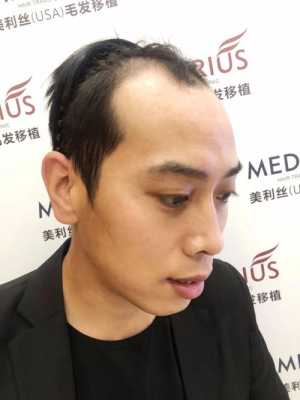 中间秃顶男士的最佳发型,头顶中间脱发怎么办啊