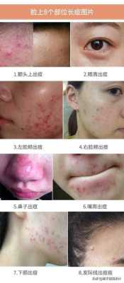脸上冒痘痘怎么快速消除,怎么样去痘痘好得快