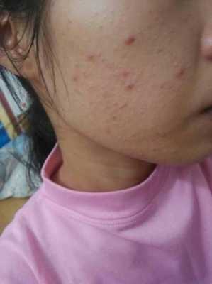 女孩脸上痘痘怎么消除呀,痘痘怎么消除小妙招女性
