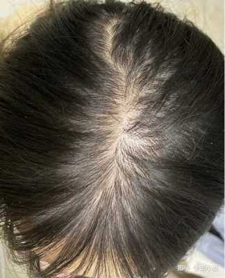 四十岁女人脱发怎么办（四十岁女人脱发怎么办吃什么药）
