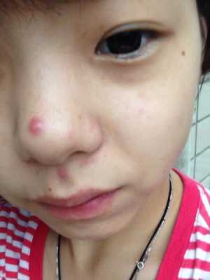 鼻尖上长痘痘怎么办（怎么去鼻上的痘痘）