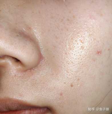 鼻子上长粉刺怎么回事（如何去除鼻子上的粉刺）