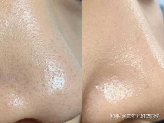 脸上毛孔大长毛怎么办（脸上毛孔大长毛怎么办?）