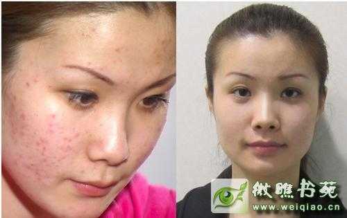 怎么才能去掉青春痘（怎么才能去掉青春痘的方法）