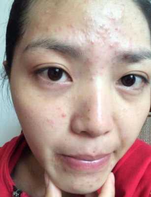 怎么去青春痘小窍门（怎么去青春痘小窍门图片）