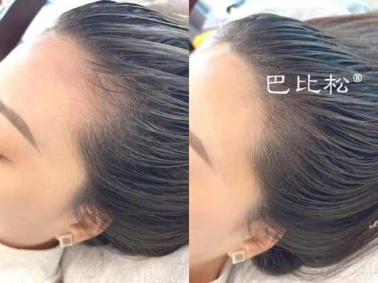 发际线没有头发怎么办（不用发际线粉怎么拯救发际线）
