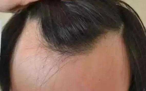 发际线向后推是怎么回事,发际线向后移是怎么回事