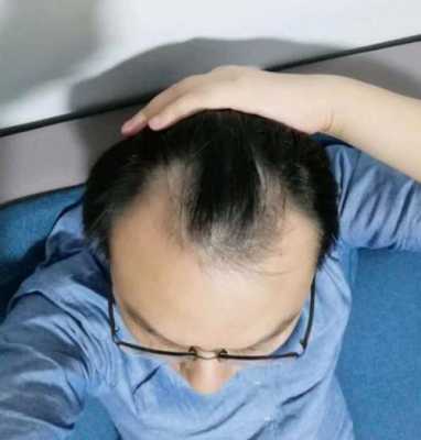 发际线向后推是怎么回事,发际线向后移是怎么回事