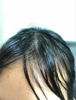 为什么头发特别容易油（为什么头发特别容易油还痒）
